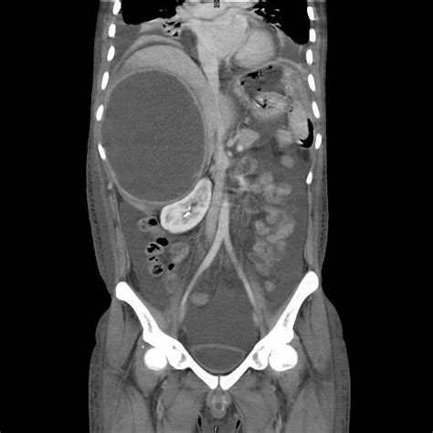 Pdf Amoebic Liver Abscess Presenting As Fever Of Unknown Origin An