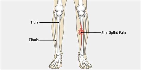 Shin Splints Causes Symptoms And Treatments