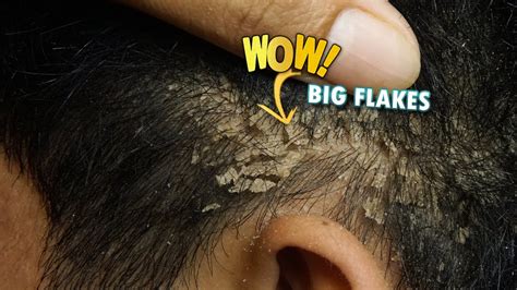 Dry Itchy Dandruff Scalp Removing And Picking 413 Youtube