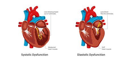 Understanding Congestive Heart Failure Symptoms Dr Raghu