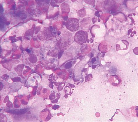 Eosinophilic Granuloma Complex Uk