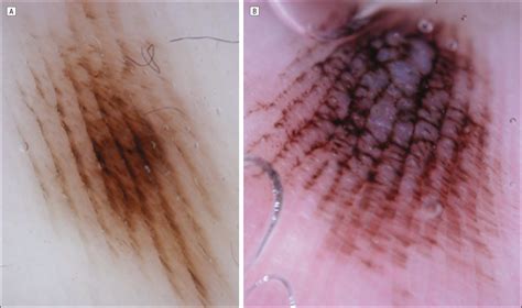 Dermoscopic Patterns Of Acral Melanocytic Nevi Dermatology Jama