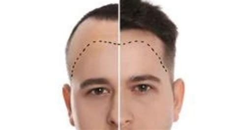 What Is A Hair Transplant Debunking 5 Myths About It Healthlinesnews