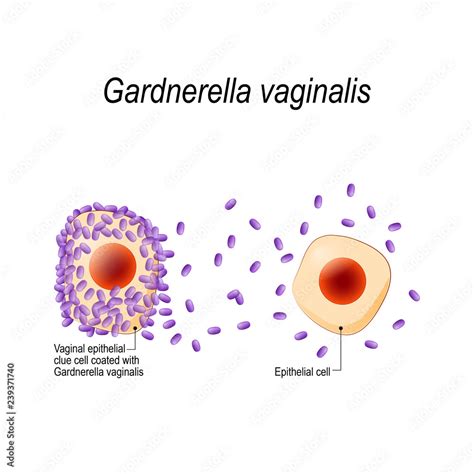 Clue Cells Gardnerella Vaginalis