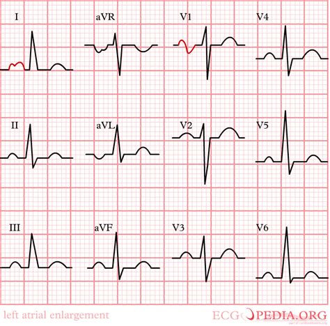 Left Atrial Enlargement Electrocardiogram Wikidoc