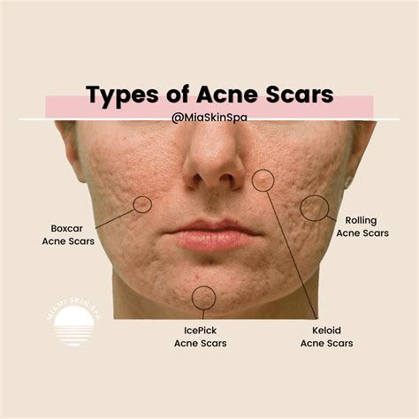 Types Of Acne Scars Pictures Diagnosis And Treatments 2023