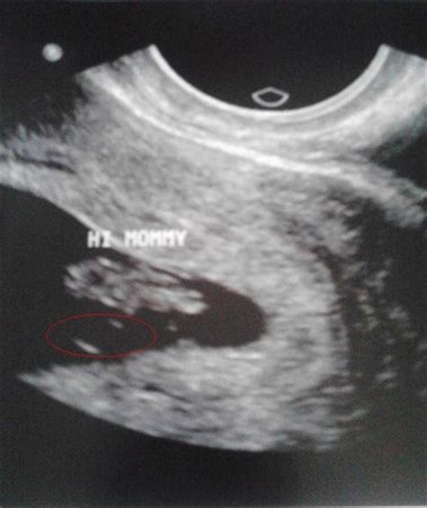 Twin pictures missed ultrasound 13 Weeks