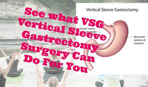 What Exactly Is Vsg Or Vertical Sleeve Gastrectomy Youtube