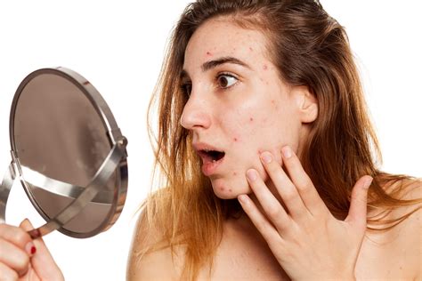Mild To Moderate Acne What Does It Look Like And How To Treat It