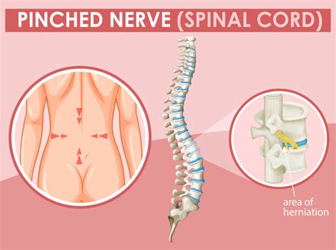 Can A Chiropractor Help A Pinched Nerve Alignology™ And Associates