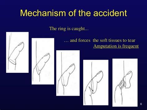 Discover More Than 62 Ring Avulsion Pics Latest Vn