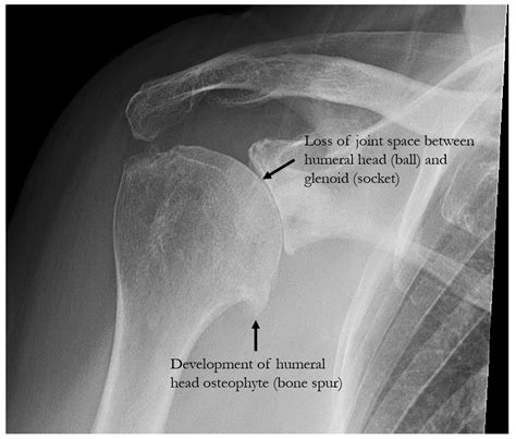 Shoulder Arthritis — Michael Fu Md Hss Shoulder Surgery