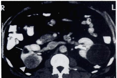 Figure 2 From Imaging Approaches To Patients With Polycystic Kidney