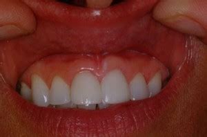 Symptoms of gum cancer may include: Take the Oral Cancer Self Exam | Greystone Smile Design