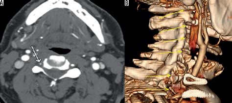 Traumatic Vertebral Artery Dissection Image Radiopaed Vrogue Co