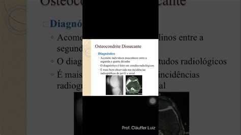 Osteocondrite Dissecante Youtube