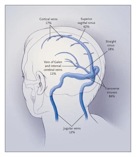 Thrombosis Of The Cerebral Veins And Sinuses Nejm