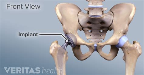 all about anterior hip replacement total hip replacement hip replacement surgery hip