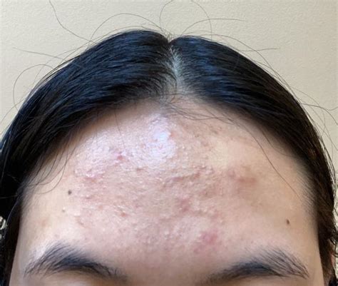 Skin Concerns Stubborn Forehead Bumps Wont Go Away Even With Ahabha