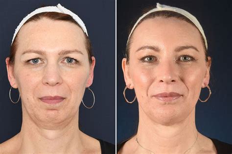 Pin On Beforeafter Facial Feminization Surgery Ffs