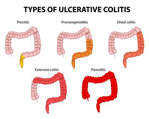 Ulcerative Colitis Colon And Rectal Surgical Specialists