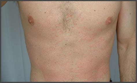 Early Stages Of Psoriasis Pictures Psoriasis Expert