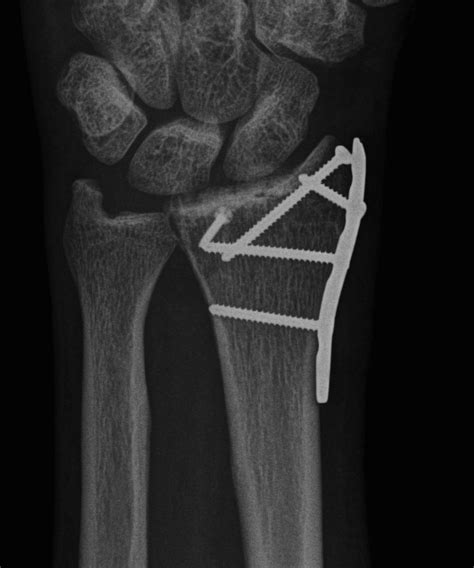 Radiocarpal And Midcarpal Dislocation The Bone School