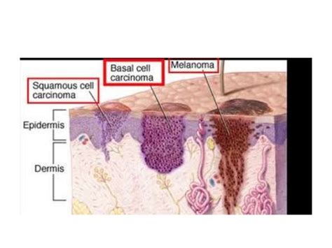 Squamous Cell Carcinoma Basal Cell Carcinoma Sebaceous Gland Carcin