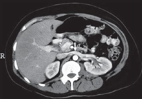 Axial Contrast Enhanced Computed Tomography Scan Shows Normal Preaortic