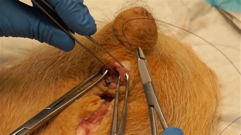 3rd And 4th Degree Perineal Laceration Repair Youtube