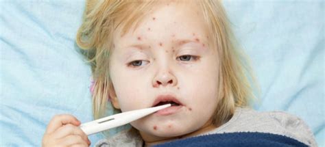 Varicella nei bambini - i principali segni della malattia ...