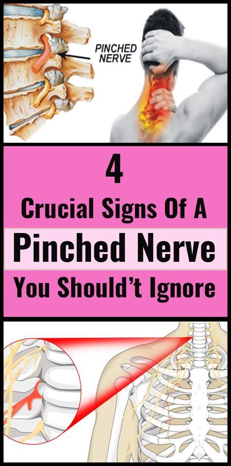 4 Crucial Signs Of A Pinched Nerve You Really Shouldt Ignore Pinched