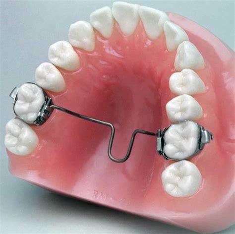 About The Tpa Orthodontic Appliance Archwired
