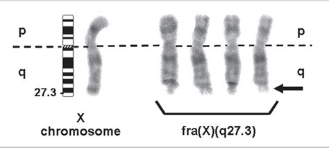 Report Of A Patient With Fragile X Syndrome Unexpectedly Identified By