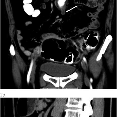 Contrast Enhanced Computed Tomography Just Before Endovascular Aneurysm