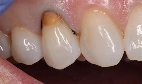 Fixing Old Fillings Dentist Houston Tx Tooth Colored Fillings