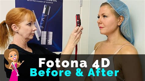 Does Fotona D Work Laser Facelift Before After Photos Skin Rejuvenation At The Womens