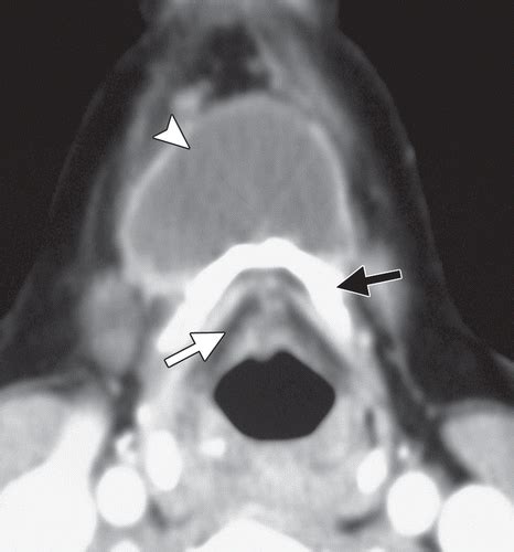 Imaging Of Ectopic Thyroid Tissue And Thyroglossal Duct Cysts