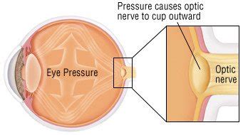 That's why half of people with glaucoma don't even know they have it. Glaucoma Guide: Causes, Symptoms and Treatment Options