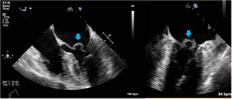 Image Arrow Indicating Mitral Valve Aneurysm In Chamber View Left