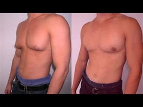 As your testosterone falls your oestrogen levels will remain higher, leading to aromatization. How To Get Rid Of Man boobs and Lose Chest Fat | Hair ...