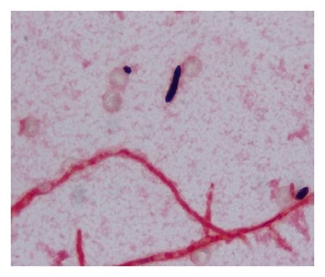 Gram Stain Of Blood Culture Showing Gram Negative Septated Hyphae And