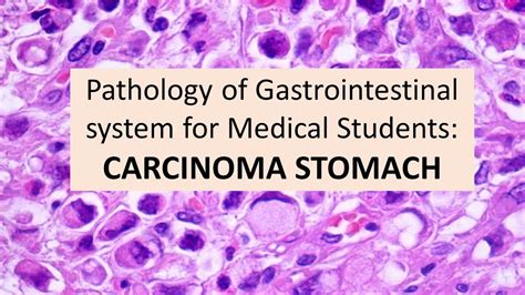 Pathology Of Gastrointestinal System For Medical Students 4 Carcinoma
