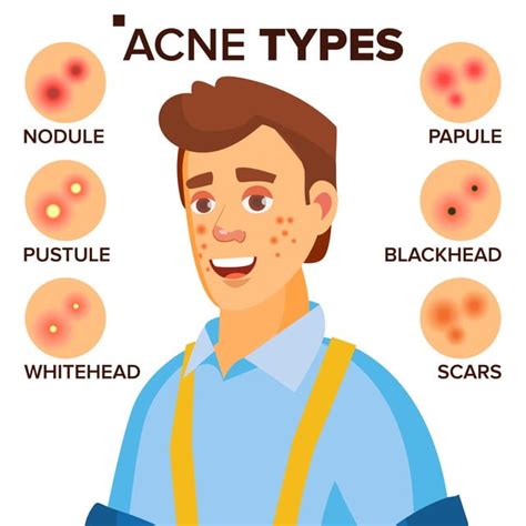 View Acne Face Map Male 