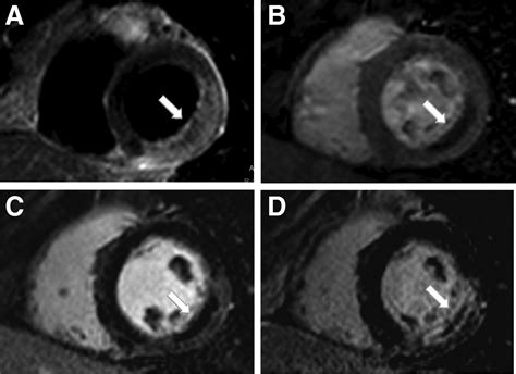 Use Of Cardiovascular Magnetic Resonance Imaging In Acute Coronary
