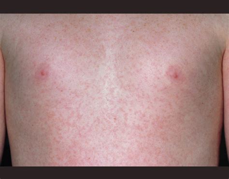 The Measles Rash Normally Appears 2 4 Days After The First Symptoms
