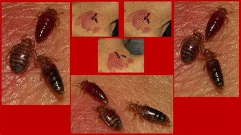 Are Bed Bugs Detrimental To Health Bed Bugs Treatment Bed Bug Bites