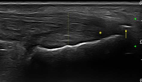 Longitudinal Ultrasound Scan Of Achilles Tendon Omeract Defined