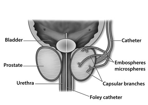 Preparing For Your Prostate Artery Embolization PAE Treatments Patients Families UW Health