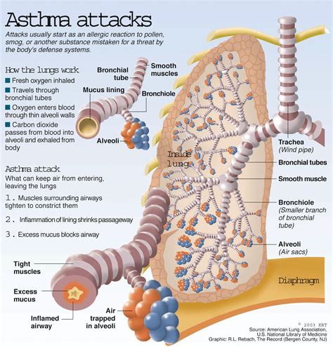 Pathophysiology Of Bronchial Asthma Adult Emergency Medicine Asthma
